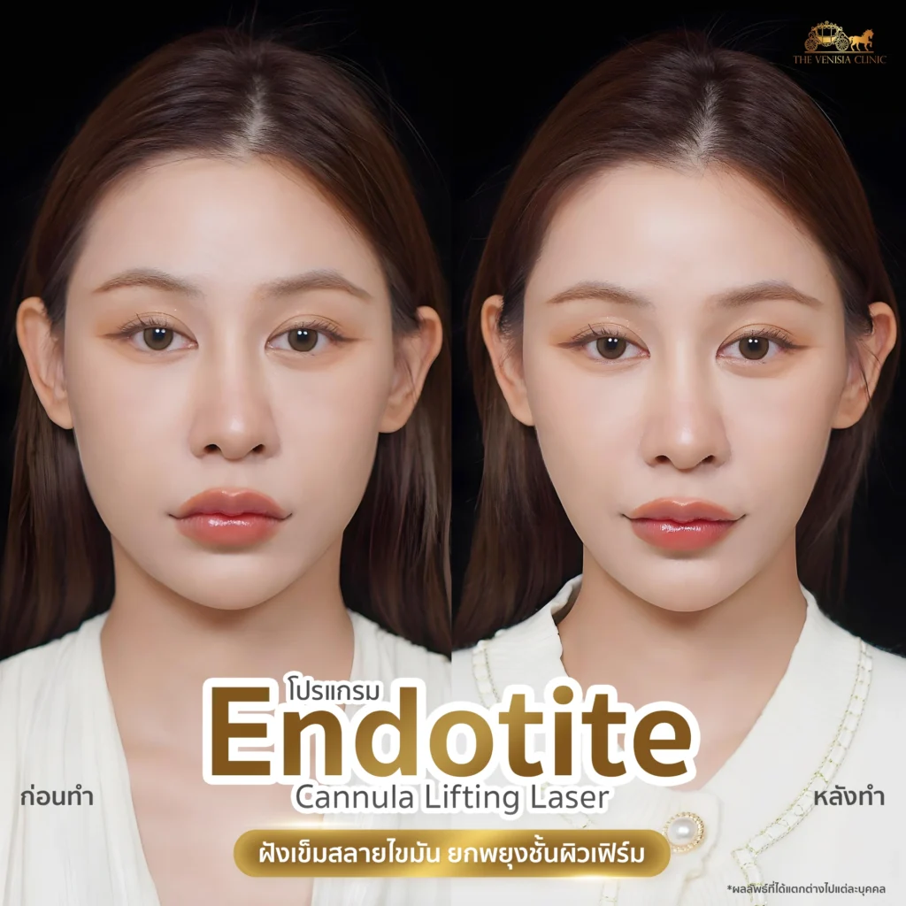 โปรแกรม ยกพยุงผิว แก้ไขความหย่อนคล้อยของผิวและริ้วรอยร่องแก้ม