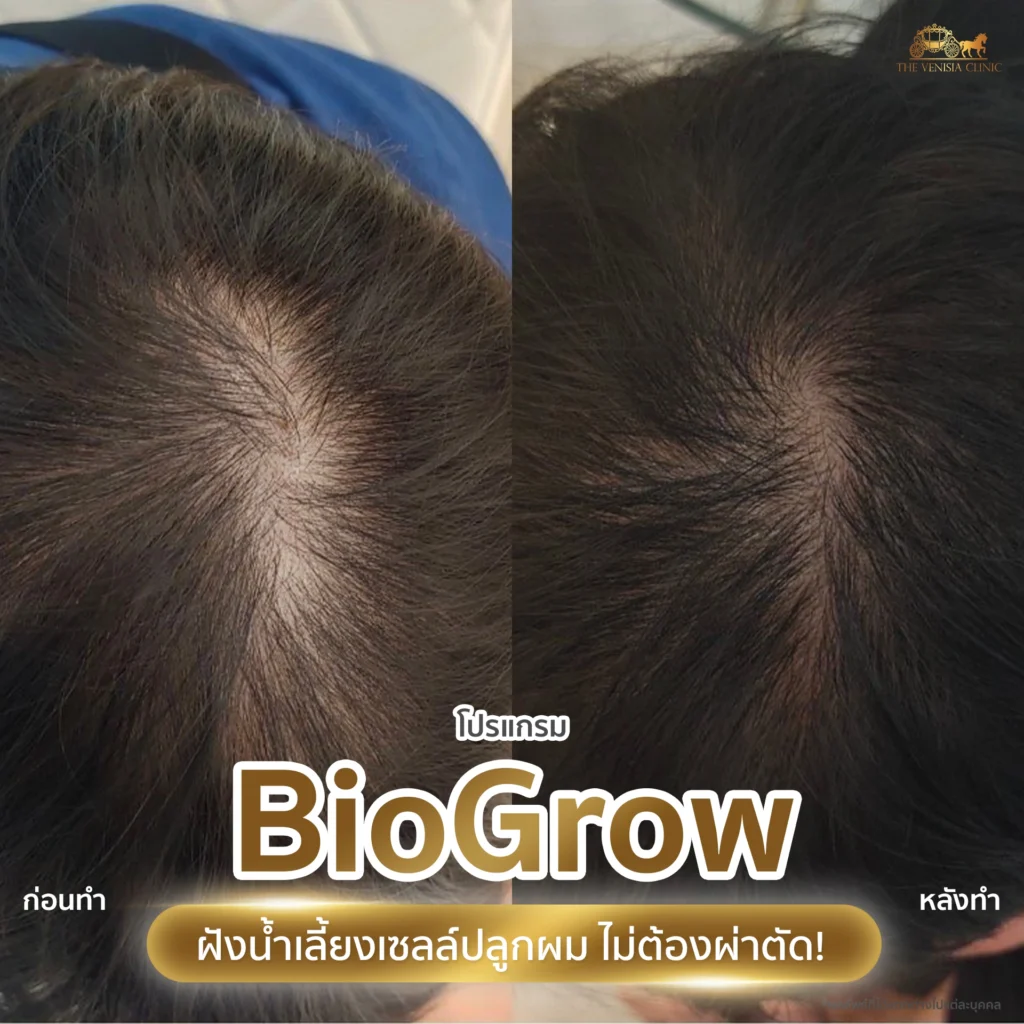 โปรแกรม BioGrow เห็นผลชัดเจน ไม่ต้องผ่าตัด