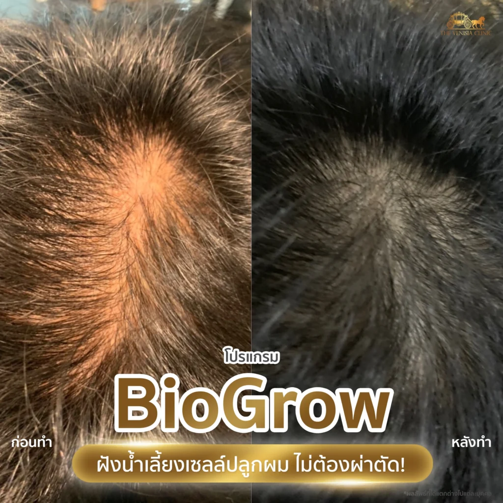 ภาพ Before After รีวิวปลูกผม บริเวณกลางศีรษะ ผมหนาแน่นขึ้น