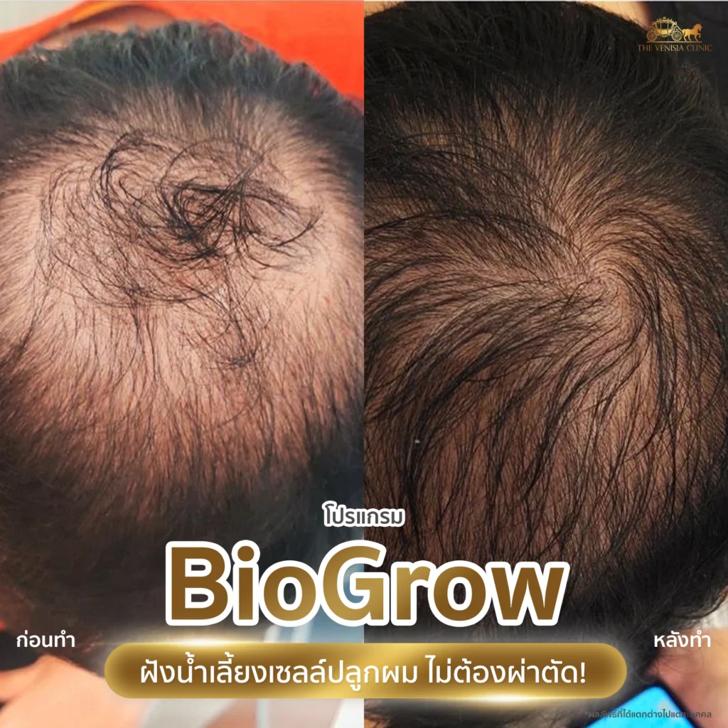รีวิวปลูกผม BioGrow ผลลัพธ์ผมหนาแน่นขึ้นจากผมบางกลางศีรษะ
