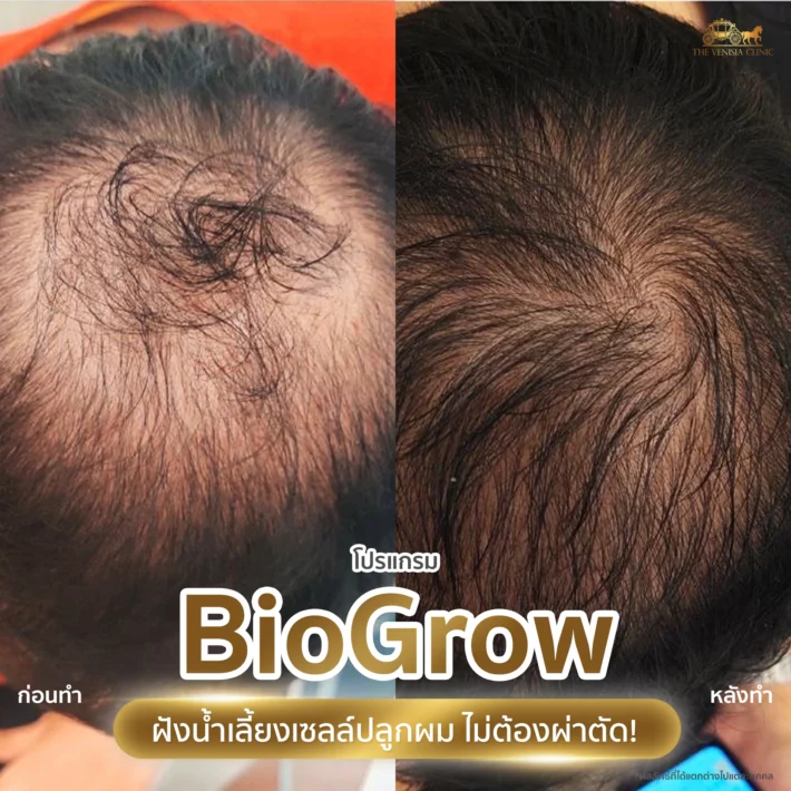 รีวิวปลูกผม BioGrow ผลลัพธ์ผมหนาแน่นขึ้นจากผมบางกลางศีรษะ