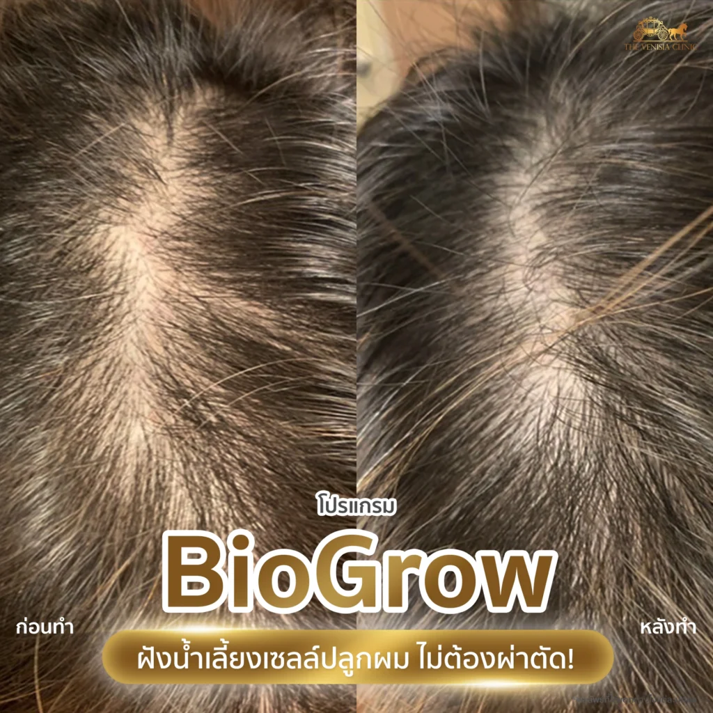 รีวิวปลูกผม สำหรับผู้มีปัญหาผมบาง ผมร่วง BioGrow ไม่ต้องพักฟื้น