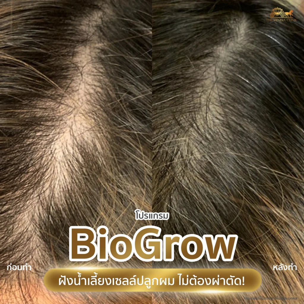 รีวิวปลูกผม ด้วย BioGrow เพื่อกระตุ้นการงอกใหม่ของเส้นผมอย่างเป็นธรรมชาติ