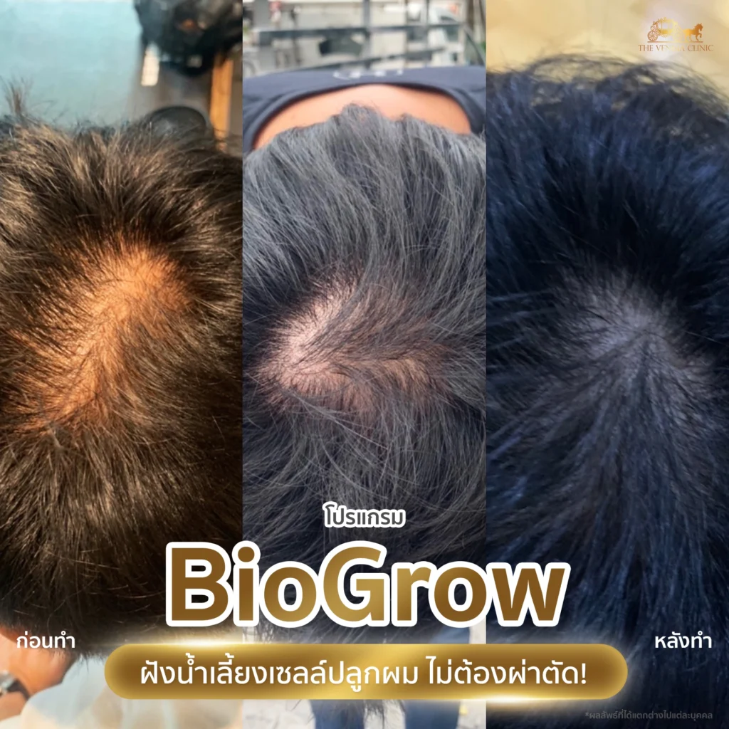 ปลูกผมชาย ผมขึ้นจริง ไม่ต้องผ่าตัด ด้วย BioGrow