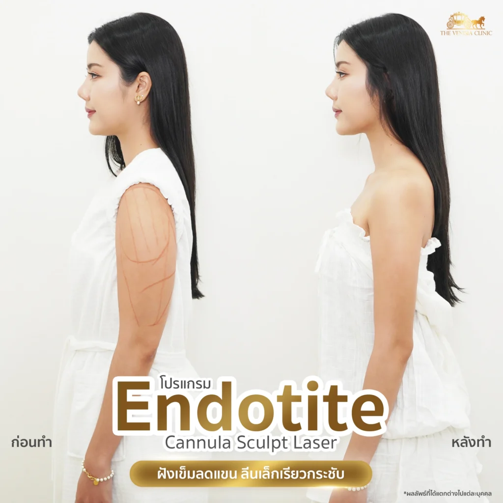 รีวิวลดต้นแขน ด้วย Endotite Sculpt Laser แขนเรียวเล็กอย่างเห็นได้ชัด