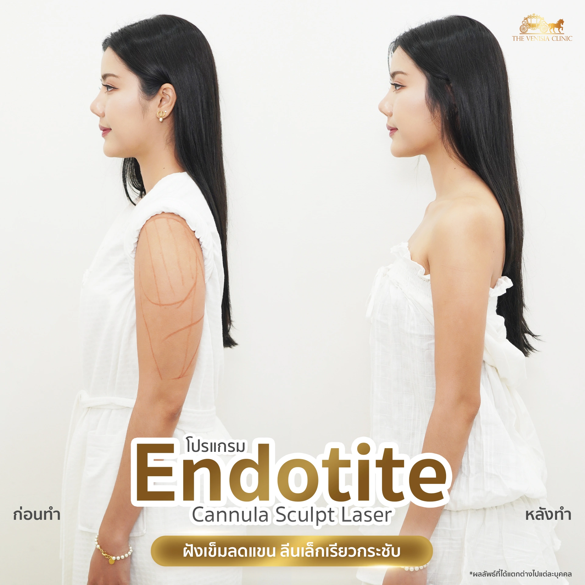 รีวิวลดต้นแขน ด้วย Endotite Sculpt Laser แขนเรียวเล็กอย่างเห็นได้ชัด