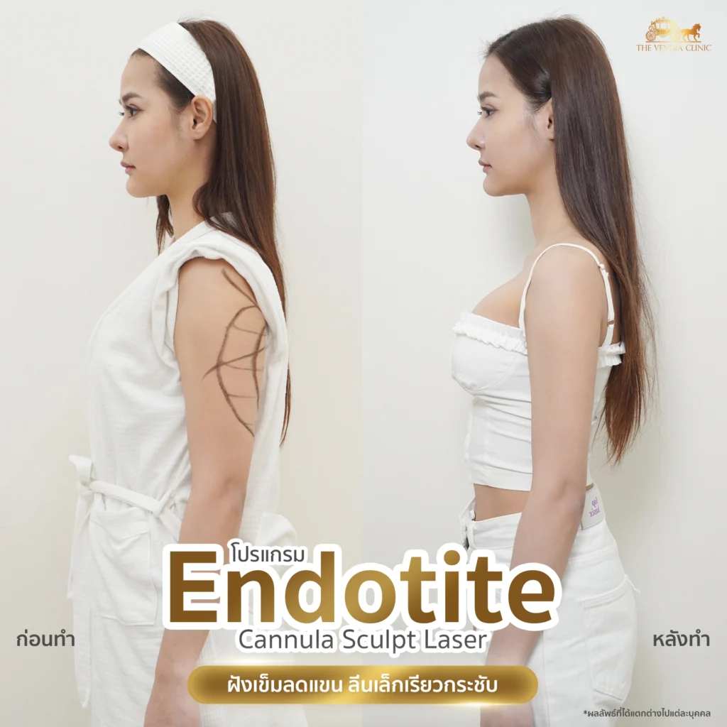 รีวิวลดต้นแขน ที่ใหญ่และย้วย ให้กระชับขึ้น หลังทำ Endotite Laser