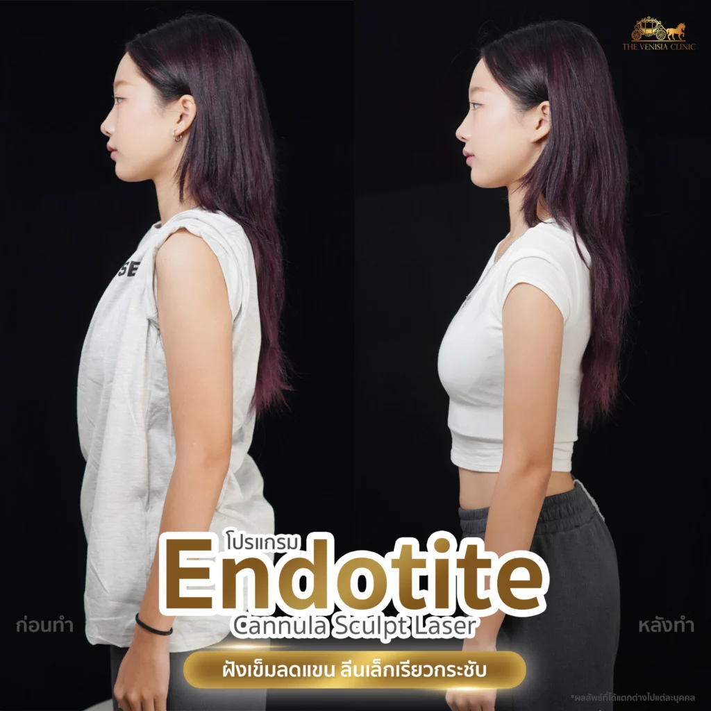 ภาพ Before After รีวิวลดต้นแขน ให้เรียวสวย ได้รูปทรงที่ต้องการ