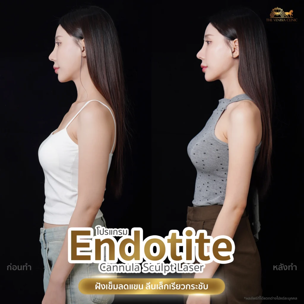 ลดต้นแขนส่วนบนและปีกหลัง ด้วย Endotite Cannula Sculpt Laser