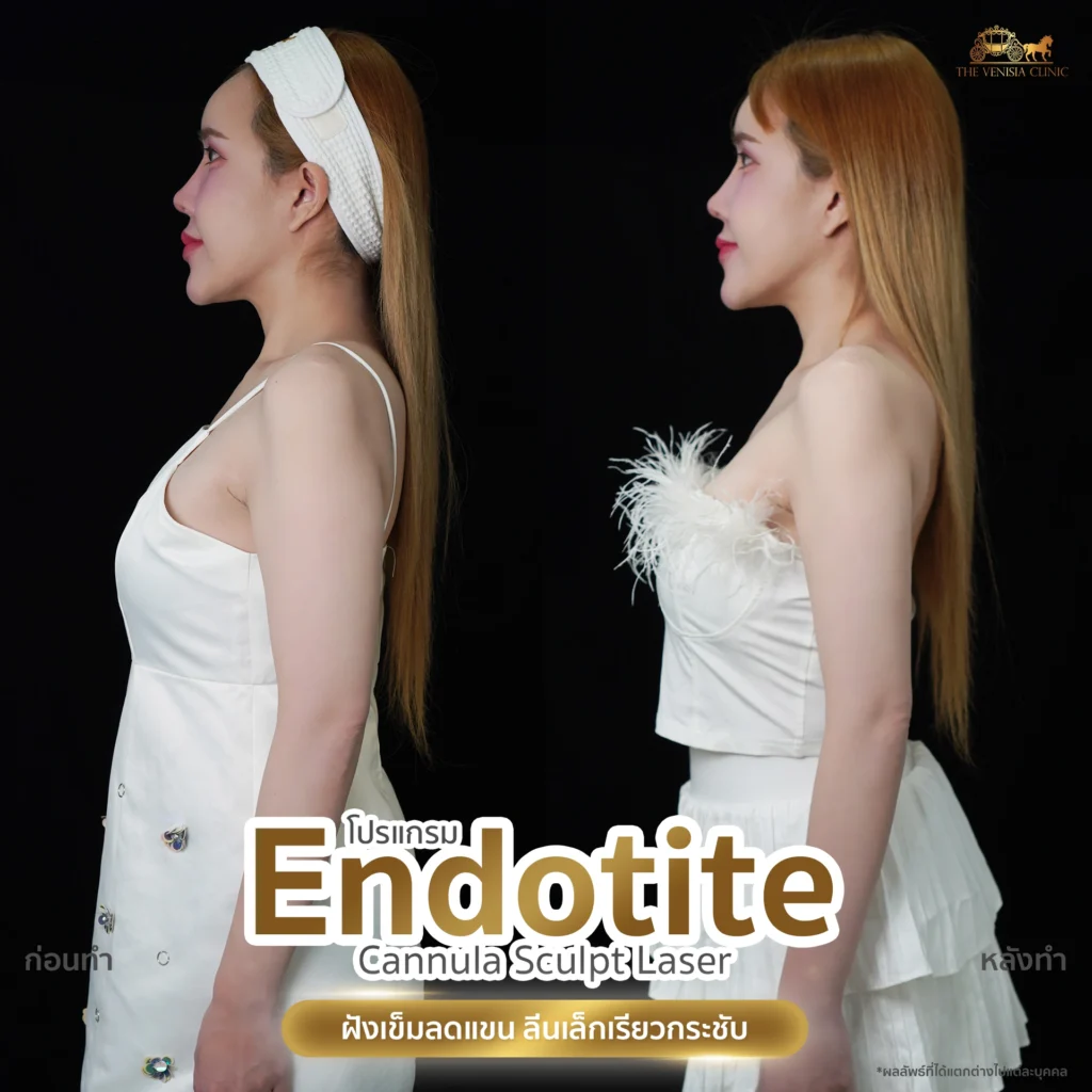 สลายไขมันและกระชับผิวบริเวณท้องแขน